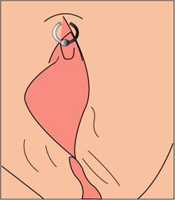 This is a picture depicting a clitoral hood piercing. It shows a ring pierced through the clitoral hood, which is the fold of skin that covers the clitoris.