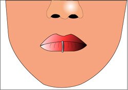 This is a picture depicting a lip piercing. The picture shows a ring pierced through the bottom lip.