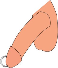 This is a picture of a reverse prince albert piercing. It shows a ring pierced through the urethra, exiting through the top of the glans or head of the penis.